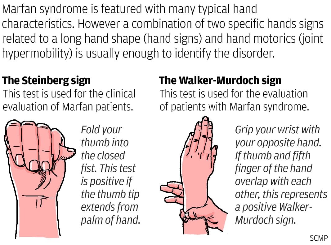 Finger length in Marfan syndrome - Mayo Clinic