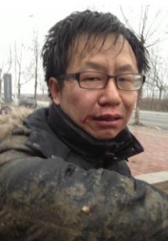 Chen Baocheng seen after he was attacked by unknown thugs near his hometown in February 2013. Screenshot from Sina Weibo.