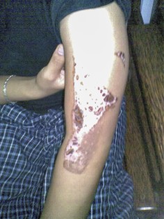 A photo taken in 2008 shows an unidentified maid showing her injuries after her employer burnt her arm with a hot iron, one of 300 cases of domestic-helper abuse documented by Hans Ladegaard.