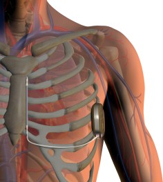 The S-ICD system is placed under the skin of the chest wall, over the ribs and sternum. Illustration: Boston Scientific