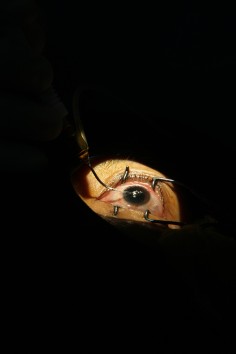 A patient undergoes cataract surgery. 