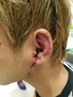 Ryuto Maekawa's eardrum after his fight against Rex Tso.