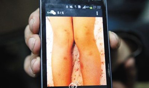 A parent shows a photo of a child's leg bruises, allegedly due to abuse from their kindergarten teacher. Photo: Weibo