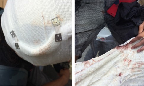 Protester Michael Cheng, who refused to have a photograph taken of his face, shows apparent injuries to his head (left) and blood stains on his towel (right). Photos: Danny Lee