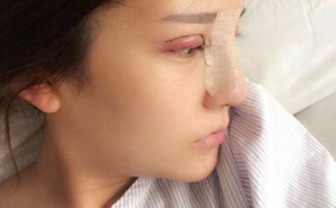 A patient after eyelid and nose surgery. 