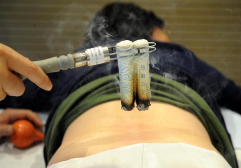 Although traditional Chinese medicine practices like moxibustion (pictured) and acupuncture remain popular in China, younger generations and wealthy Chinese seem to put more faith in Western medicine and hospitals and doctors outside the country. Photo: Xinhua