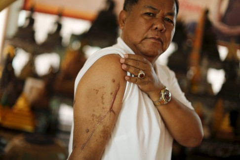 Red shirt movement leader Kwanchai Praipana shows a scar on his right arm, after he was shot by an unidentified gunman last year at his office in Udon Thani, Thailand. Photo: Reuters