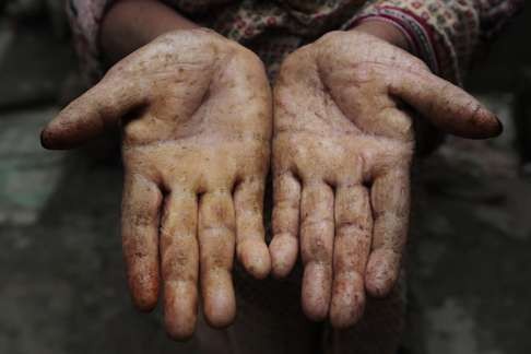 A woman shows her palms, affected by years of drinking arsenic-laced water. Photo: AP