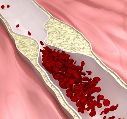 Atherosclerosis happens when plaque blocks bloodflow in the arteries.