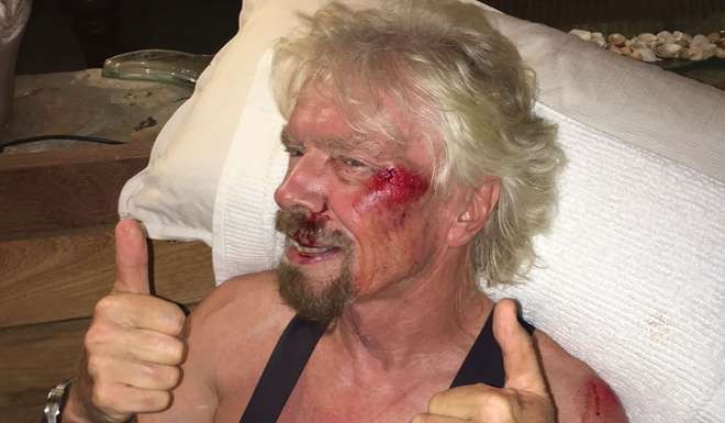 Richard Branson gives a thumbs up showing injuries after a biking accident on Virgin Gorda in the British Virgin Islands in the Caribbean. Photo: AFP