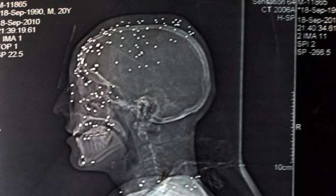 An X-ray of a man with pellet injuries to his head. Photo: SCMP Picture