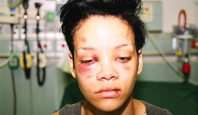 Rihanna after being beaten by Chris Brown.